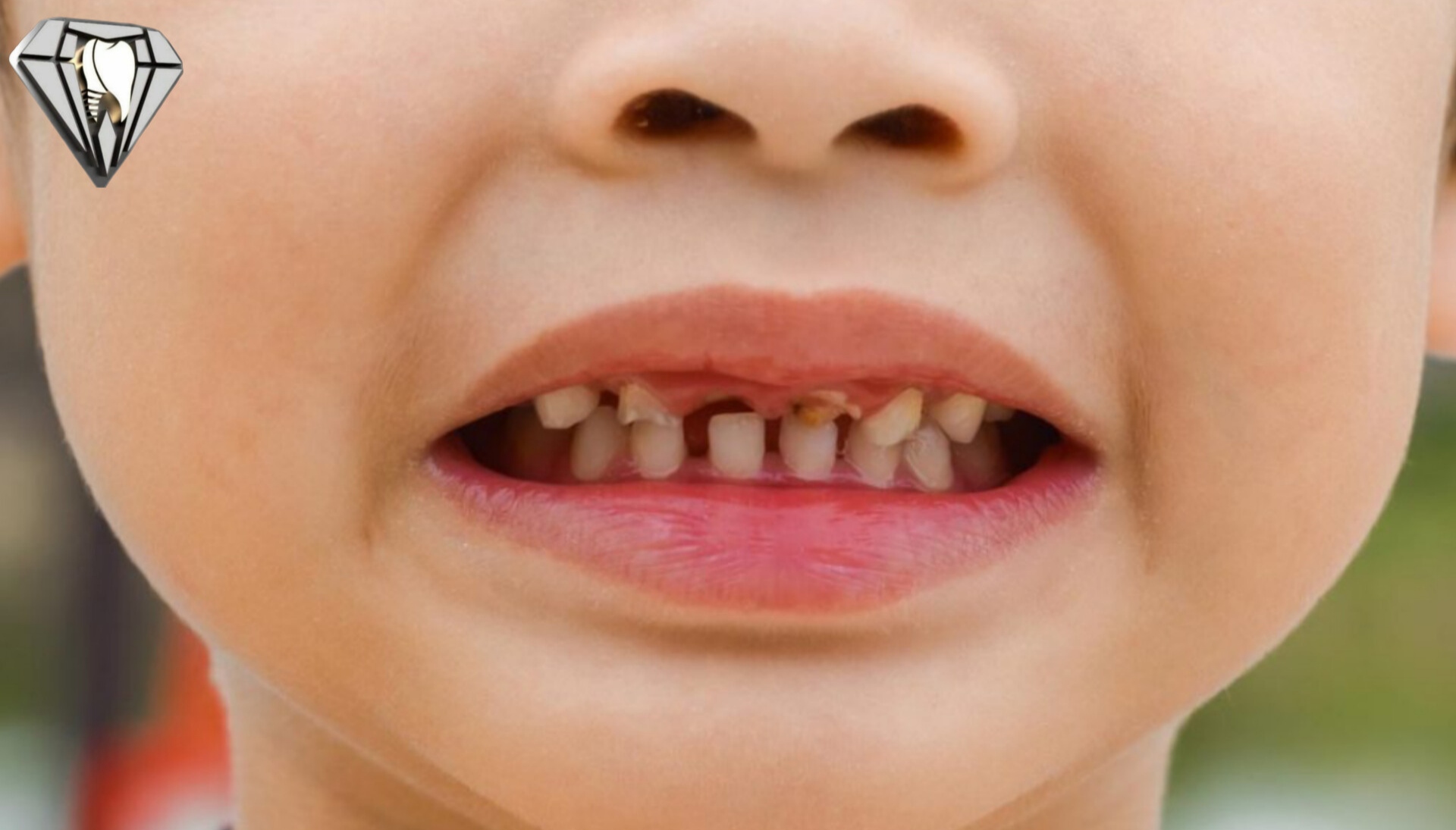 مسواک نزدن دندان باعث خرابی دندان ها میشود