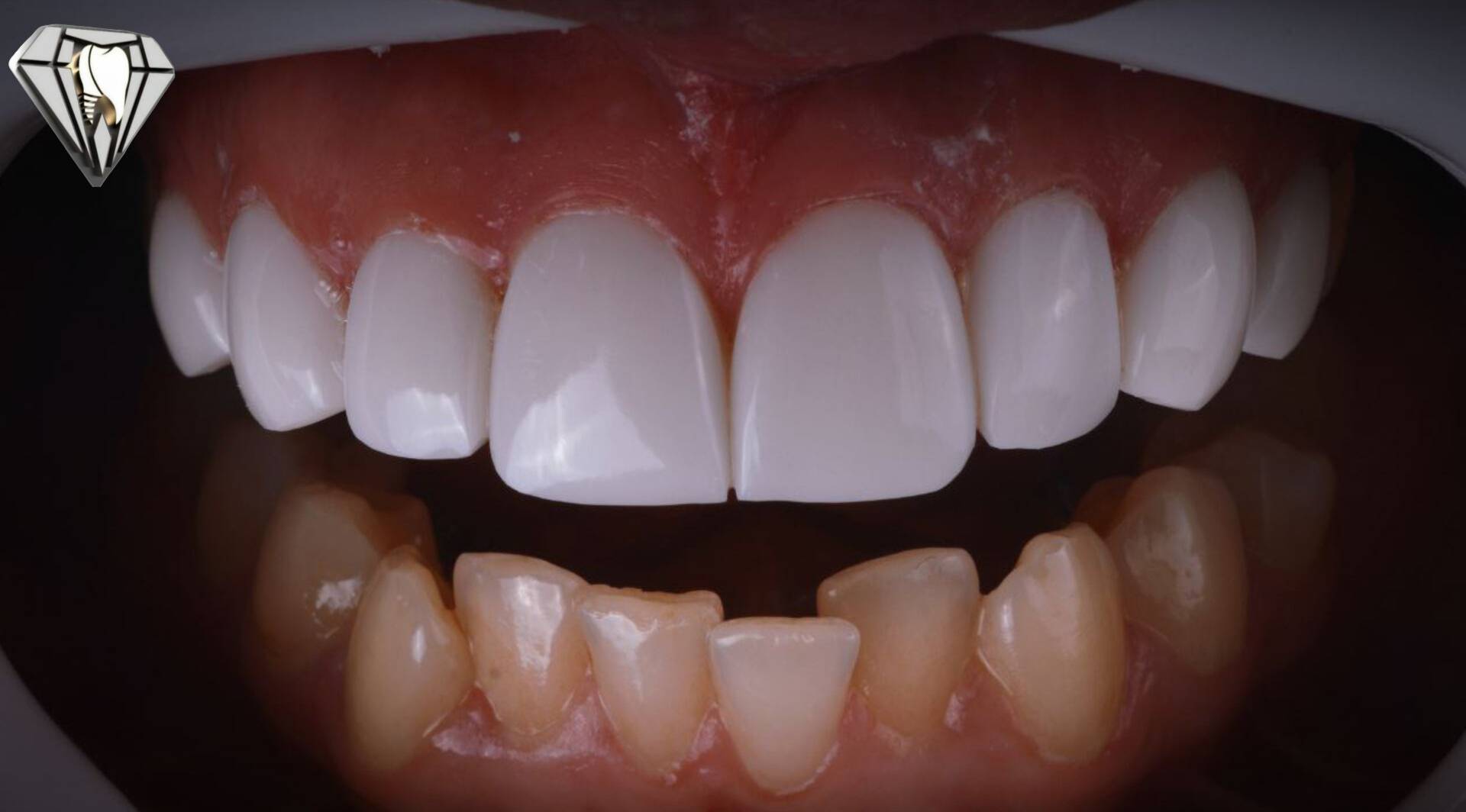 نمای کلی کامپوزیت دندان