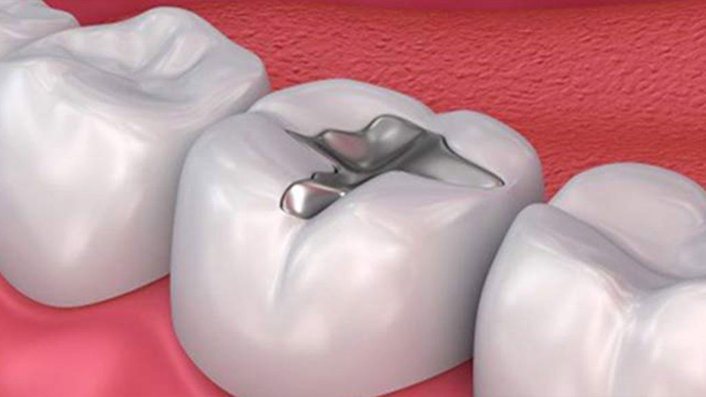 اصطلاحات دندانپزشکی ترمیم دندان