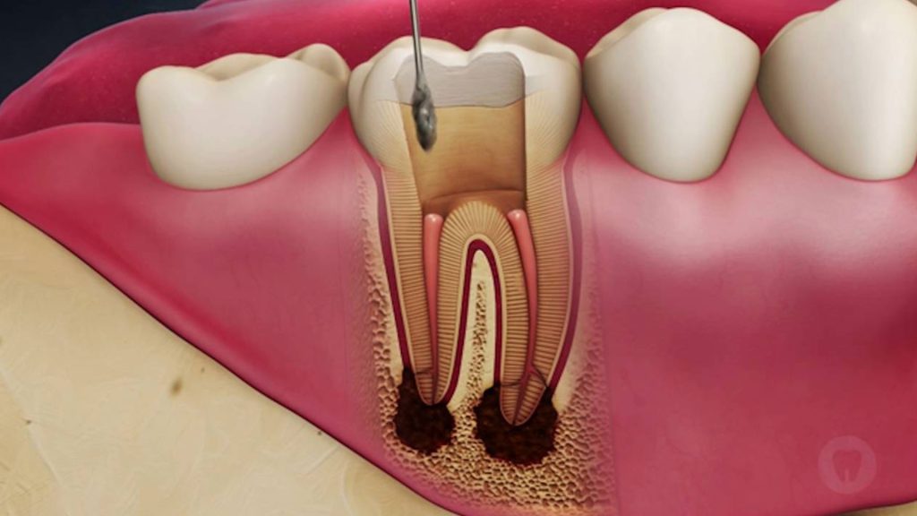 اصطلاحات دندانپزشکی درمان ریشه
