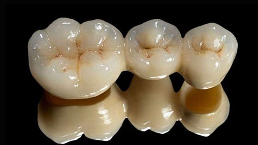 اصطلاحات دندانپزشکی روکش دندان