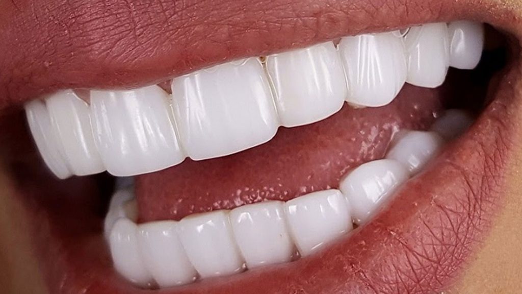 اصطلاحات دندانپزشکی کامپوزیت