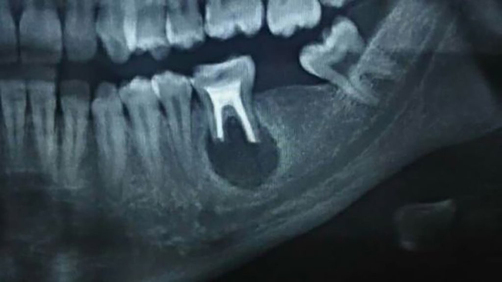کیست های دندانی دندان پزشکی برلیان  