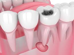 کیست های دندانی دندان پزشکی برلیان 