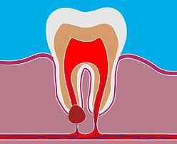 کیست های دندانی دندان پزشکی برلیان