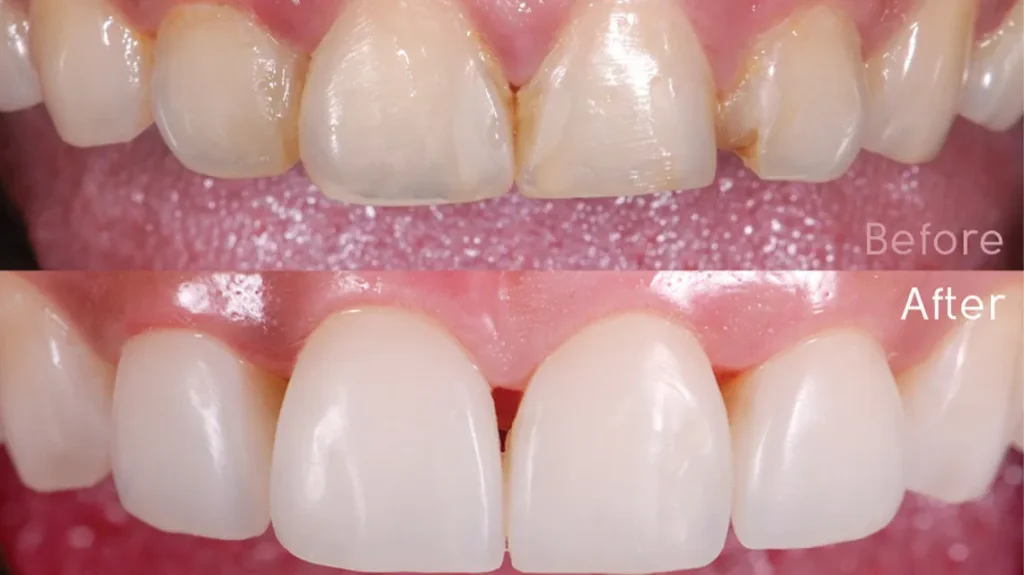 انواع کامپوزیت دندان