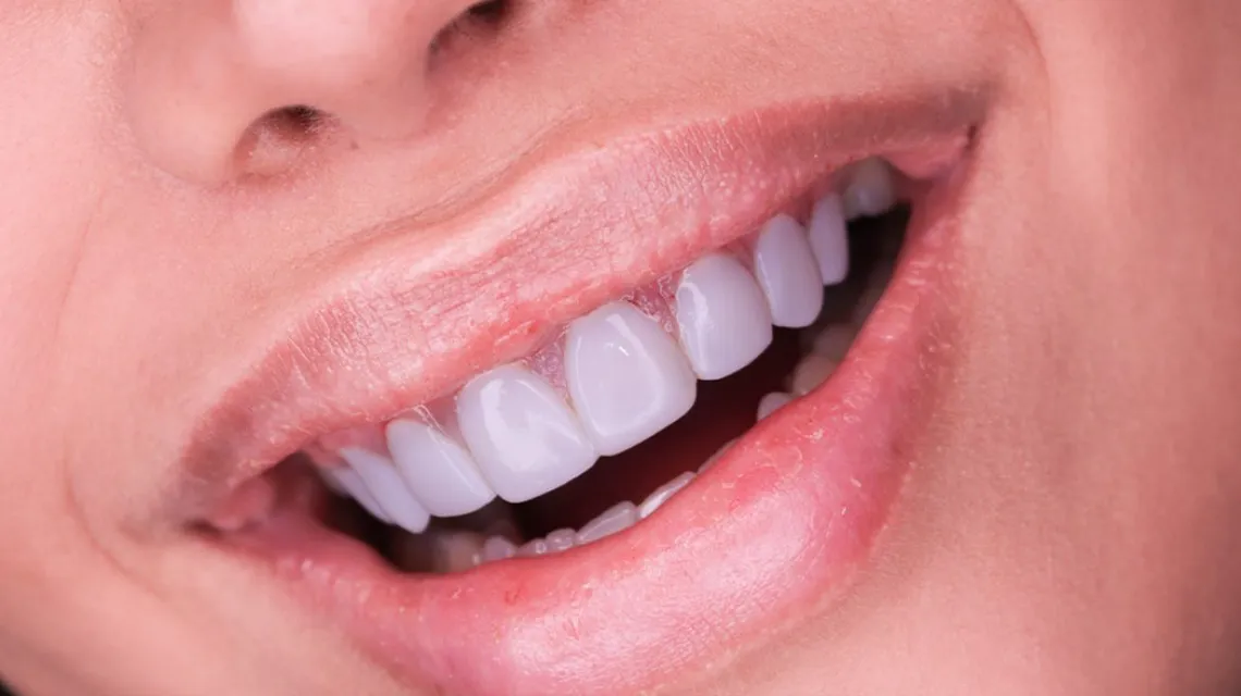 مراحل لمینت دندان