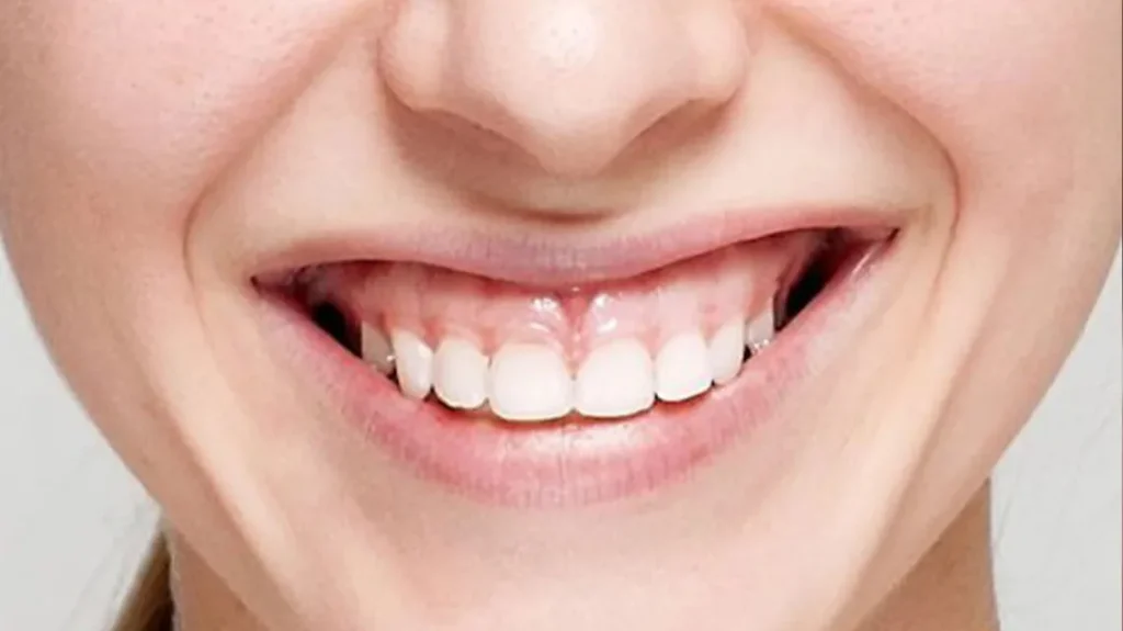 جراحی لثه 2 جراحی لثه