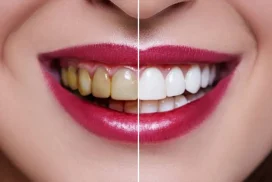 لمینت یا کامپوزیت