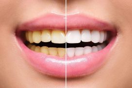 teeth scaling