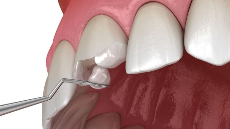 دندان پزشکی برلیان قرچک-ایا کامپوزیت دندان میریزد؟