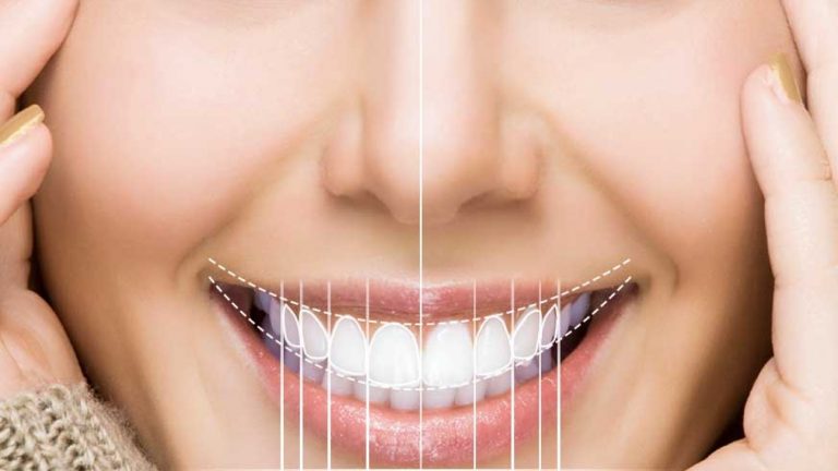 دندان پزشکی برلیان قرچک-ایا کامپوزیت دندان میریزد؟