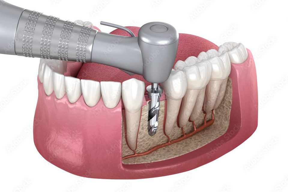 دندانپزشکی برلیان قرچک -ایمپلنت به روش پانچ چیست؟