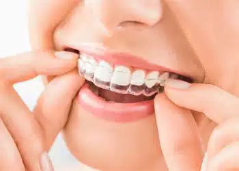 پرانتز نامرئی دندان