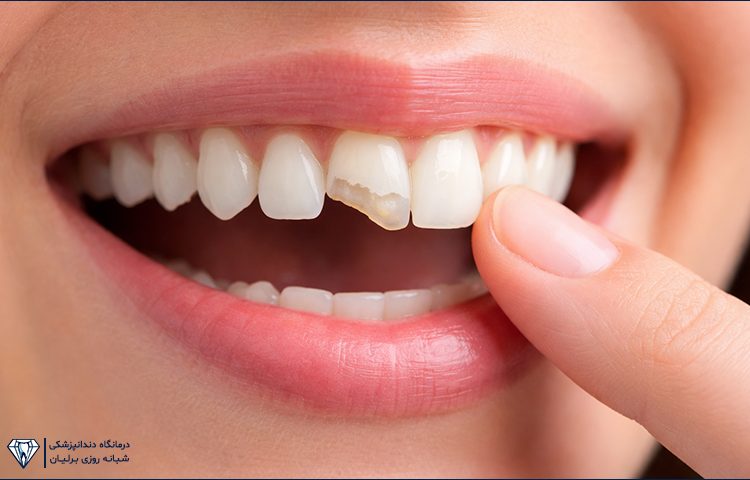 اگر دندان شکست چه کار کنیم؟