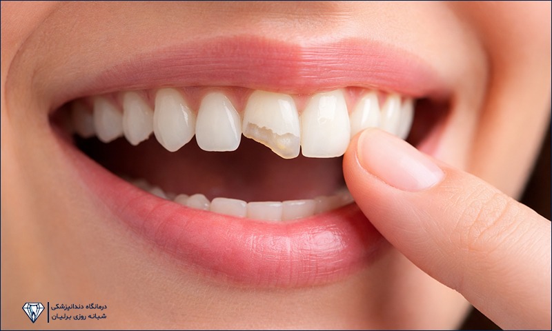 اگر دندان شکست چه کار کنیم؟