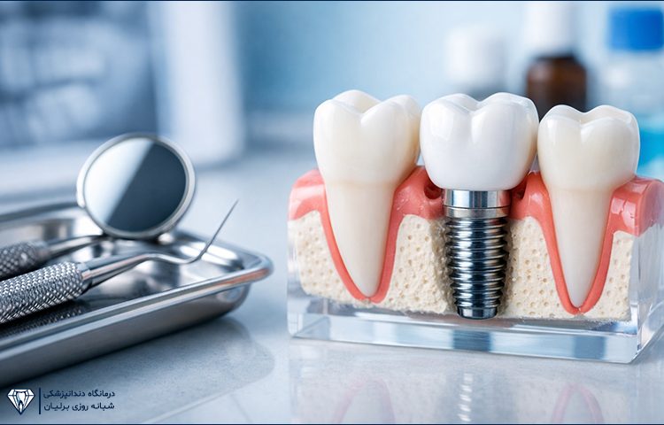 ویژگی‌های یک ایمپلنت دندان خوب