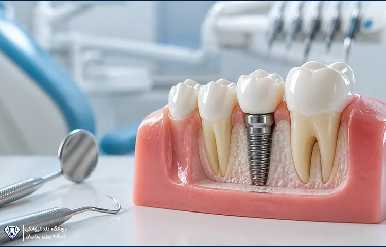 بهترین روش جایگزینی دندان از دست رفته کدام است؟