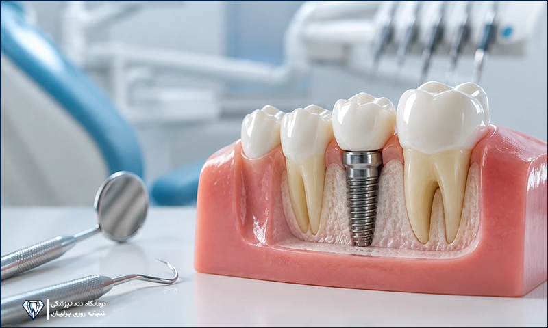 بهترین روش جایگزینی دندان از دست رفته کدام است؟