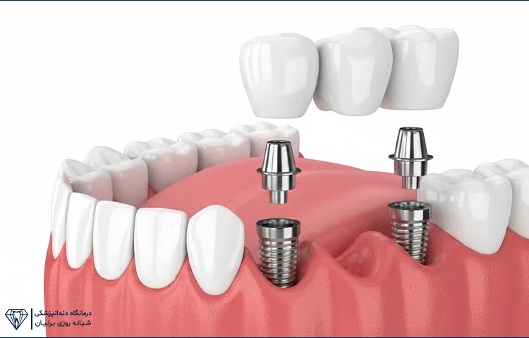 چند دندان را میتوان همزمان ایمپلنت کرد؟