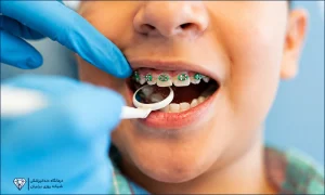 ارتودنسی پیشگیری در کودکان از چه سنی لازم است؟