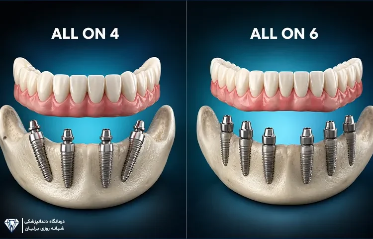 تفاوت All-on-4 و All-on-6