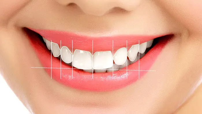 طراحی لبخند هالیوودی